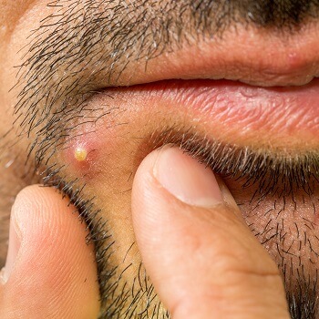 Lumpy Abscess Lump Diagnosis & Treatment | Push Doctor