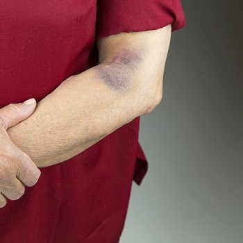 Bruising Causes & Treatment | Push Doctor