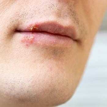 Herpes Cold Sores Symptoms And Causes Push Doctor