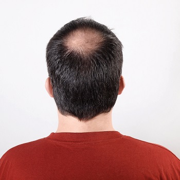 Male Pattern Baldness Signs & Treatment | Push Doctor