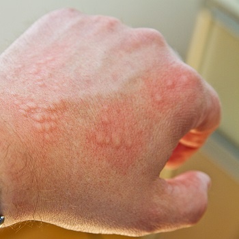Three million doses will arrive each month in. Moderna Ausschlag Arm - Skin Rash Causes and Treatment | Push Doctor
