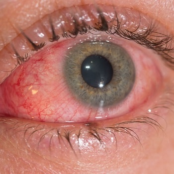 close up conjunctivitis