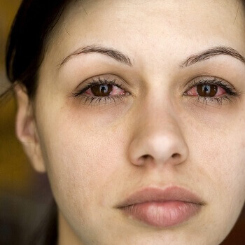 conjunctivitis symptoms