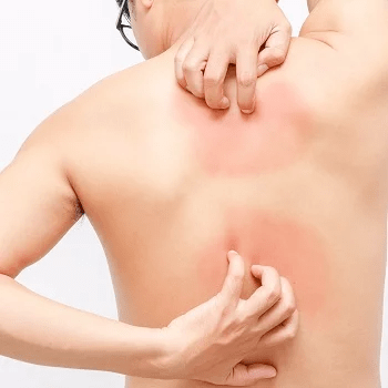 View Intertrigo Treatment Uk Images